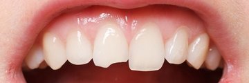 Скол зуба: виды и способы лечения
