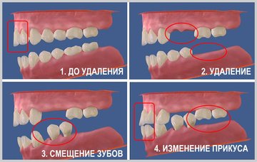 Последствия жизни без зубов