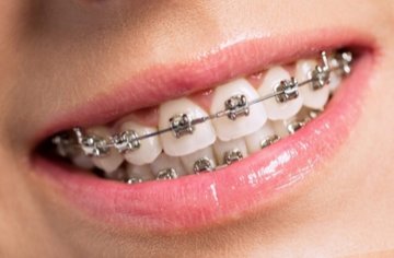 Брекеты — самые популярные ортодонтические системы